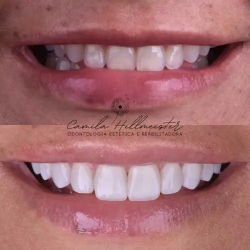 Facetas de Resina Composta